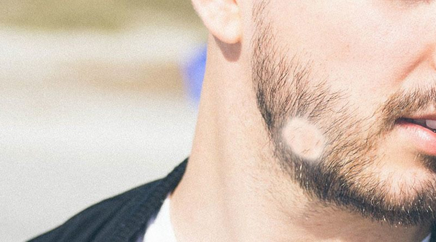 alopecia areata barba