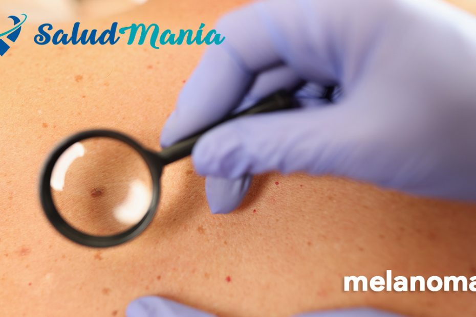 Melanoma: comprendiendo el cáncer de piel más agresivo